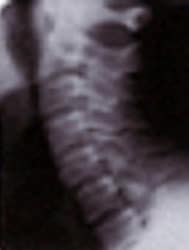 Normal 75-Year-Old Cervical Spine
