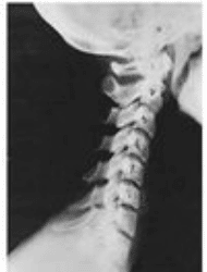 Phase One Cervical Spine