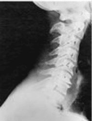 Phase Three Cervical Spine